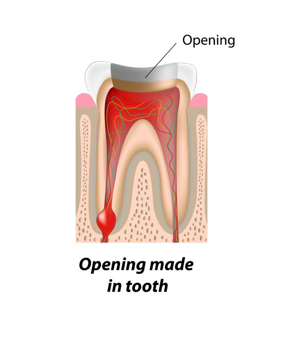 Endodontist Procedures