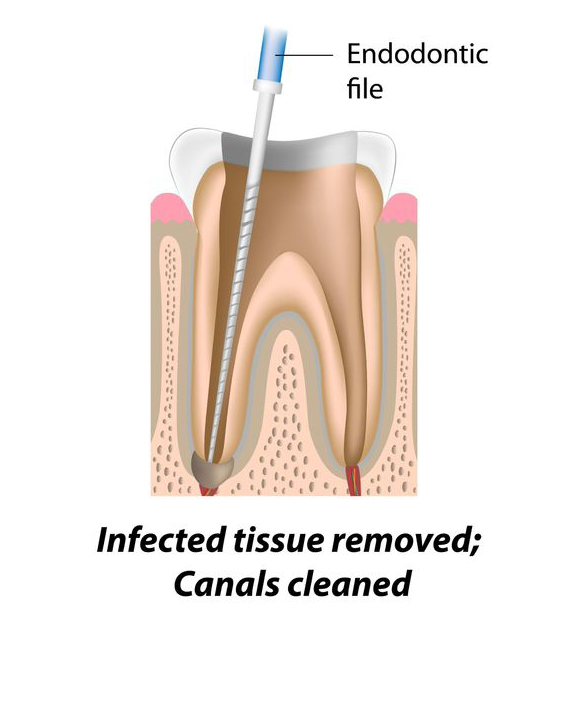 Endodontist Procedures