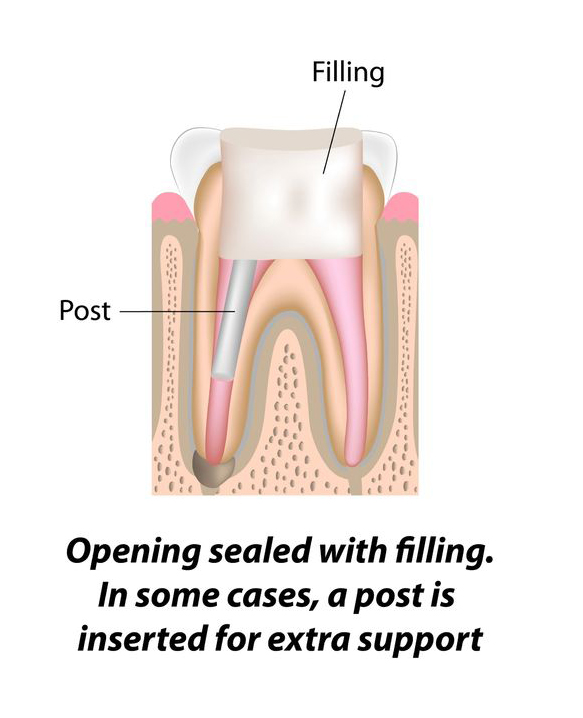 Endodontist Procedures